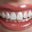Виниры на зубы: секрет идеальной улыбки!