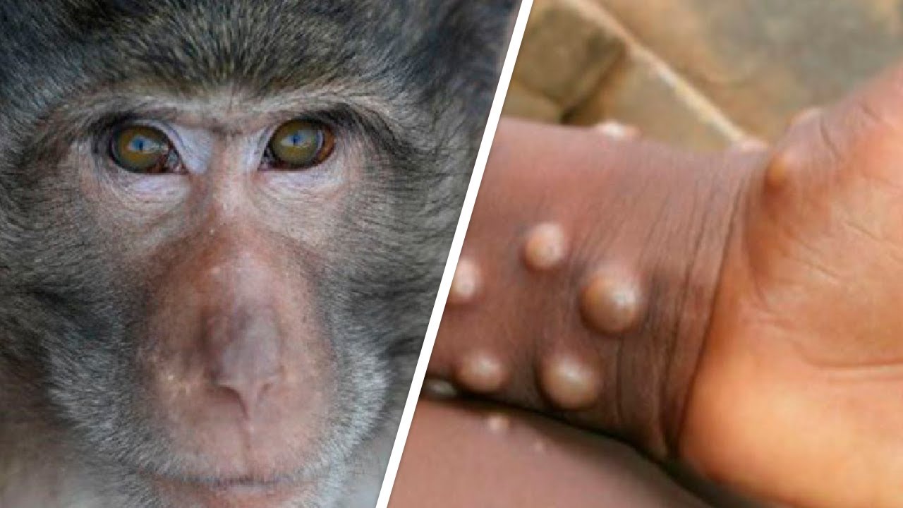 В мире циркулирует новый вирус — оспа обезьян